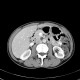 Cyst of pancreas, pancreatic cyst: CT - Computed tomography